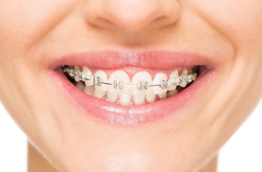 Clear Braces Adults 60