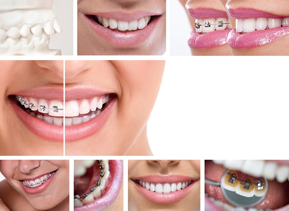 any dental plans that cover orthodontics