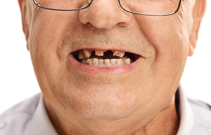 missing-my-teeth