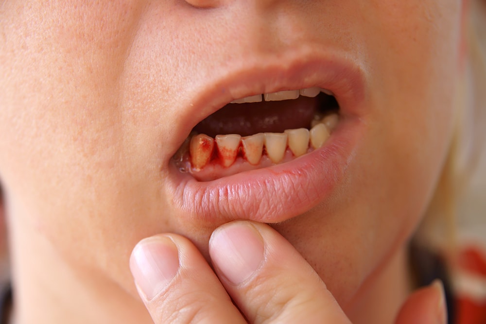 Image result for teeth bleeding