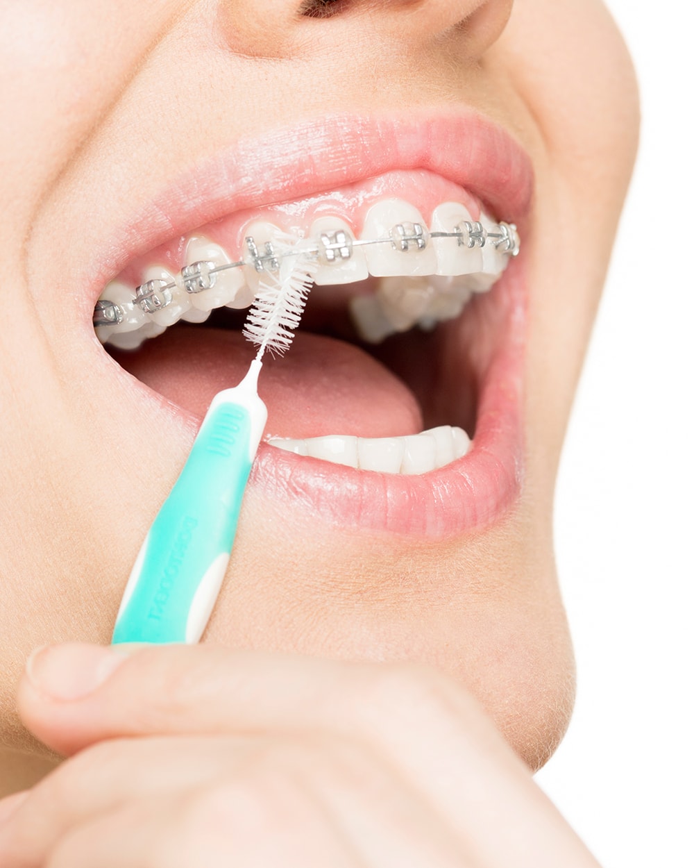 Flossing teeth with braces.