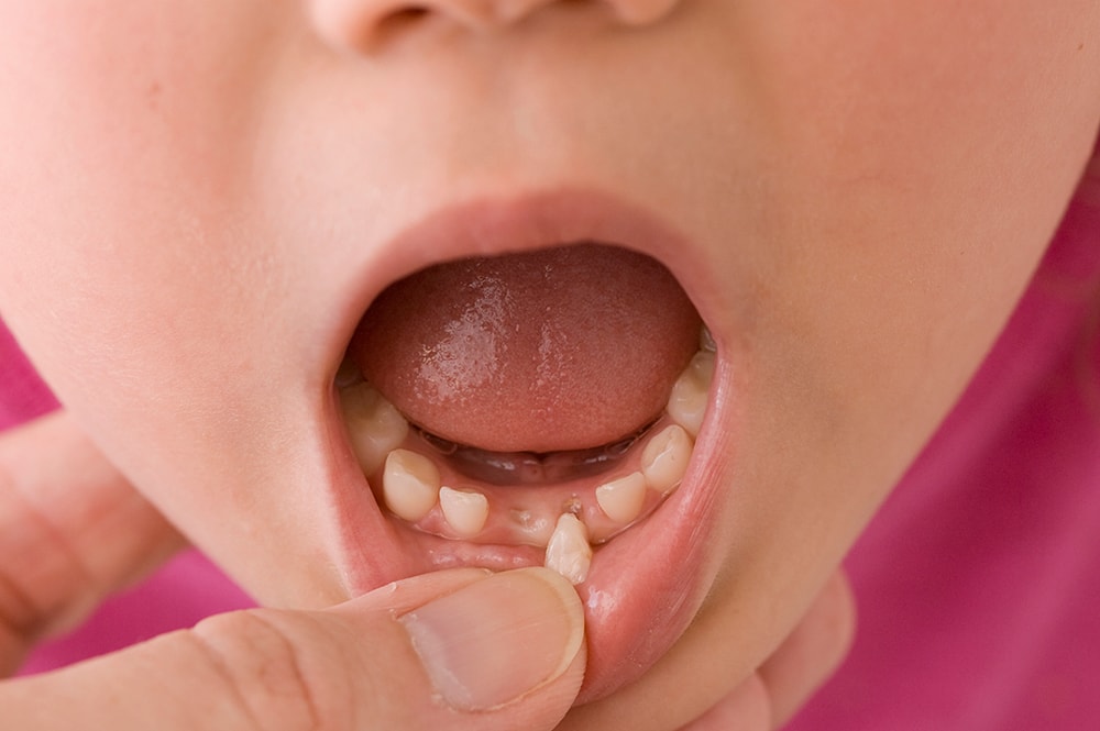 Child with loose tooth.