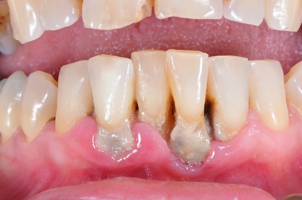 what-is-the-main-cause-of-gum-disease