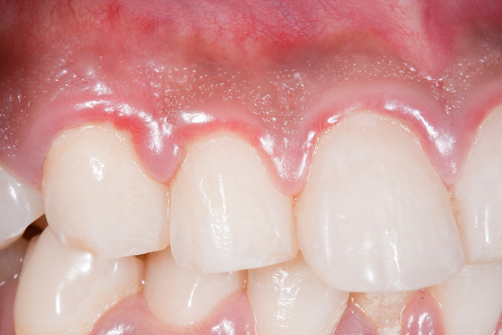 Can Swollen Gums Cause A Sore Throat