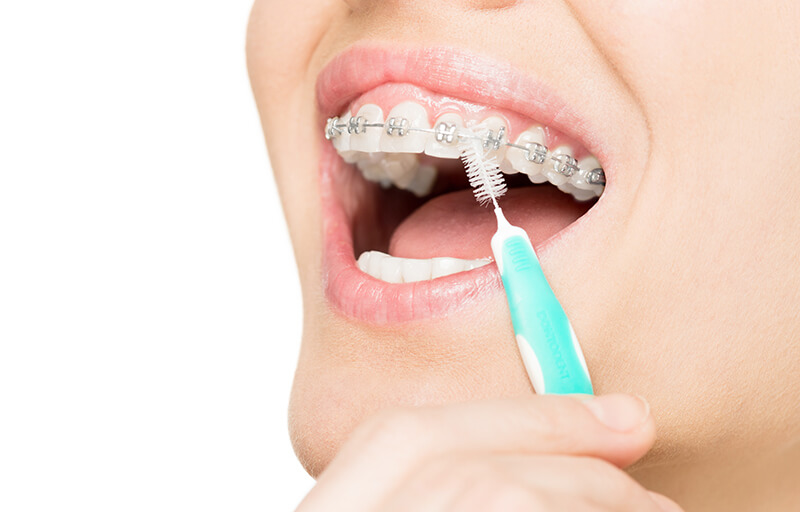 Brushing teeth with braces.