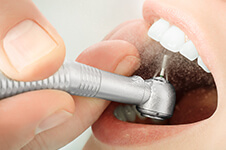 Image for Article: Does Getting Your Teeth Cleaned Hurt?