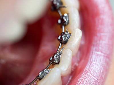 Image for Article: What Are Lingual Braces?&nbsp;